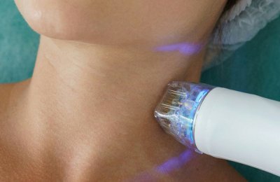 Microneedling