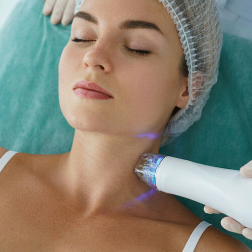 Microneedling 